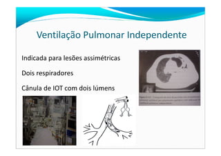 Indicada para lesões assimétricas
Dois respiradores
Ventilação Pulmonar Independente
Cânula de IOT com dois lúmens
 