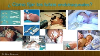 Dr. Marco Rivera Meza
¿ Como fijar los tubos endotraqueales?
 