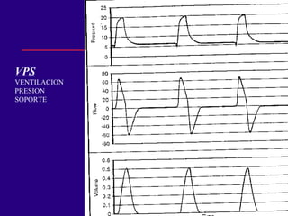VPS
VENTILACION
PRESION
SOPORTE
 