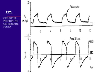 VPS
CICLO POR
PRESION, NO
CRITERIO DE
FLUJO
 