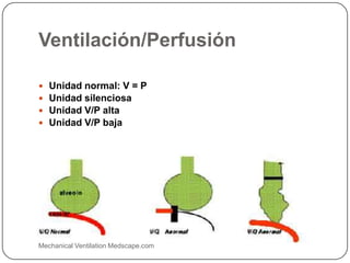Ventilación/Perfusión
 Unidad normal: V = P
 Unidad silenciosa
 Unidad V/P alta
 Unidad V/P baja
Mechanical Ventilation Medscape.com
 