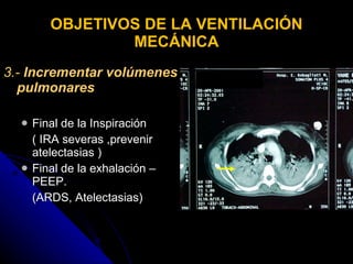 OBJETIVOS DE LA VENTILACIÓN MECÁNICA 3.-  Incrementar volúmenes pulmonares Final de la Inspiración  ( IRA severas ,prevenir atelectasias ) Final de la exhalación – PEEP. (ARDS, Atelectasias) 