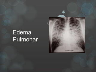 Edema
Pulmonar
 