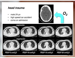 Ventilação Mecânica no TCE