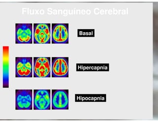 Ventilação Mecânica no TCE