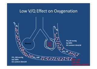 Low V/Q Effect on Oxygenation
Low V/Q Effect on Oxygenation

Low
L
V/Q

Normal

PO2 50 mmHg
Sat 80%
O2 content 16ml/dl

PO2 50
PO2 100 mmHg
g
Sat 100%
O2 content 20ml/dl

PO2 100

PO2 = 60
Sat  90%
O2 content 18ml/dl

 