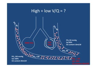 High + low V/Q = ?
High + low V/Q = ?

HIGH V/Q

Low
L
V/Q

PO2 50 mmHg
Sat 80%
O2 content 16ml/dl

PO2 50
PO2 130 mmHg
g
Sat 100%
O2 content 20ml/dl

PO2 130

PO2 = 60
Sat  90%
O2 content 18ml/dl

 