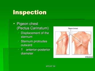 Inspection
 Pigeon chest
  (Pectus Carinatum)
   Displacement of the
    sternum
   Sternum protrudes
    outward
   h anterior-posterior
    diameter


                     MTCAT '09
 