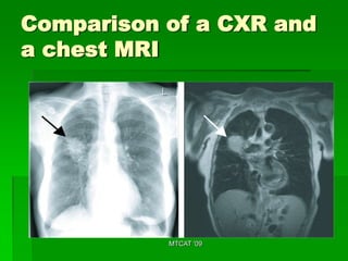 Comparison of a CXR and
a chest MRI




           MTCAT '09
 