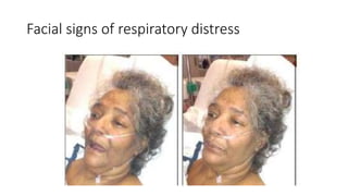 Facial signs of respiratory distress
 