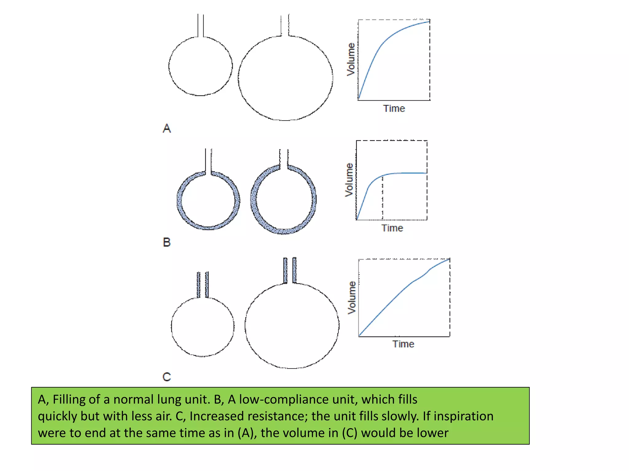 A, Filling of a normal lung unit. B, A low-compliance unit, which fills
quickly but with less air. C, Increased resistance; the unit fills slowly. If inspiration
were to end at the same time as in (A), the volume in (C) would be lower
 