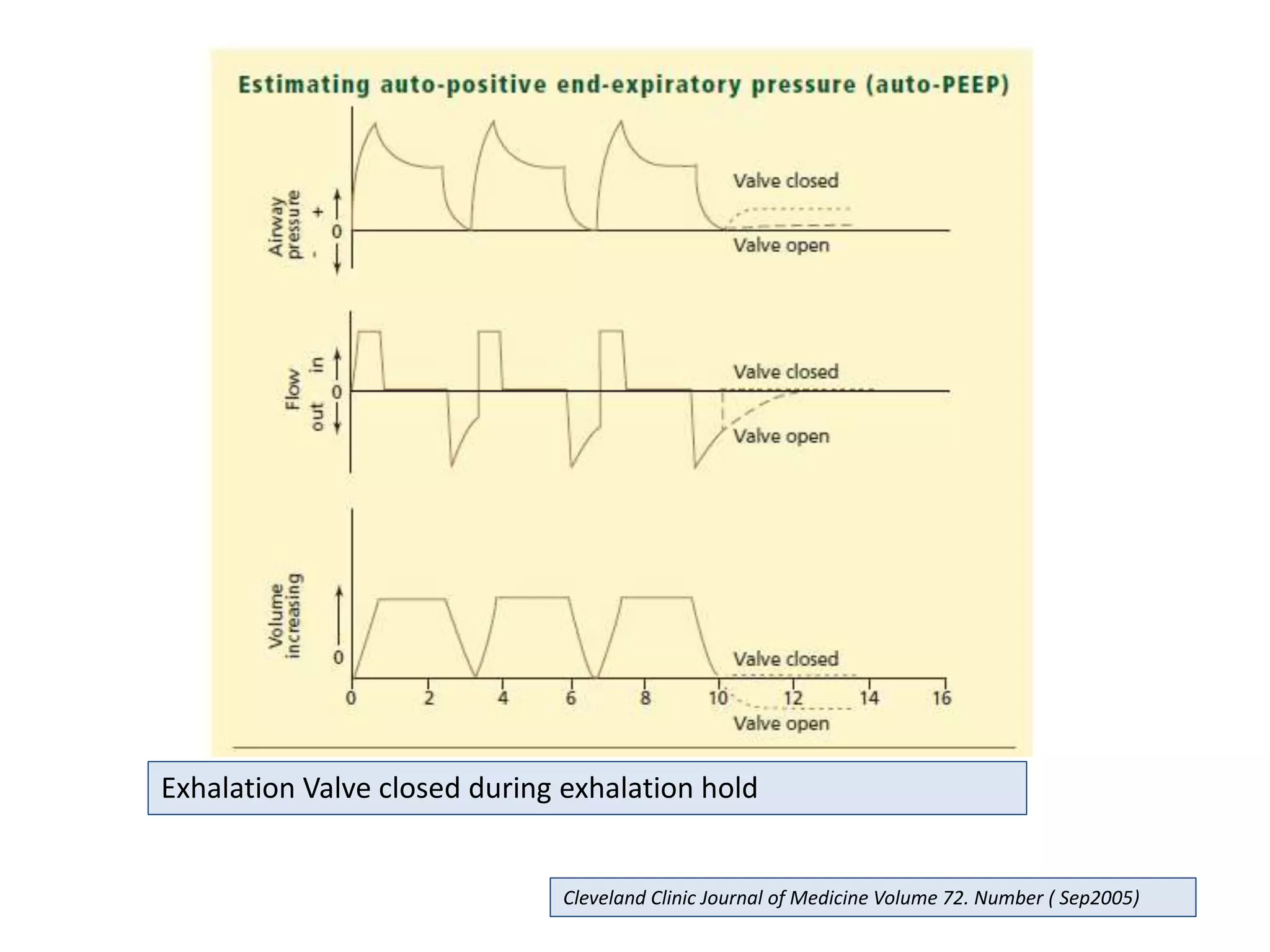 Exhalation Valve closed during exhalation hold
Cleveland Clinic Journal of Medicine Volume 72. Number ( Sep2005)
 