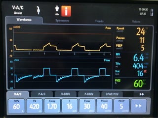 Mechanical Ventilation modes used in critical care | PPTX