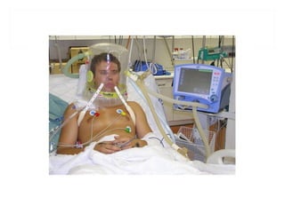 Ventilation non invasive