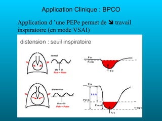 Application Clinique : BPCO

Application d ’une PEPe permet de  travail
inspiratoire (en mode VSAI)
 