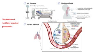 Ventilator-Associated Pneumonia (VAP) Surveillance Strategies, VAE ...