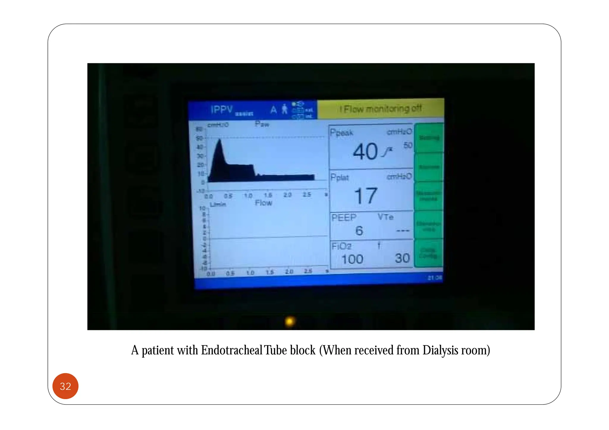 A patient with EndotrachealTube block (When received from Dialysis room)
32
 