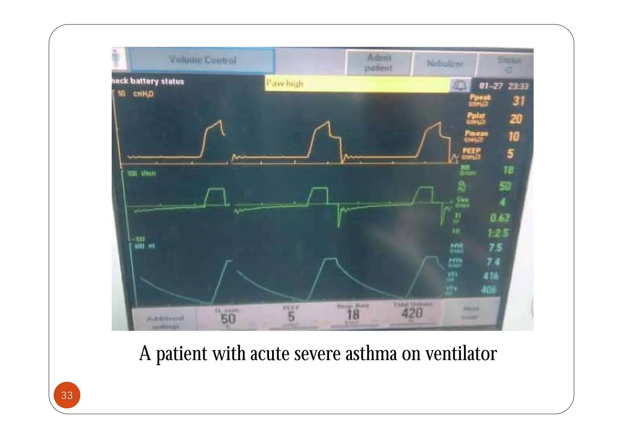 A patient with acute severe asthma on ventilator
33
 