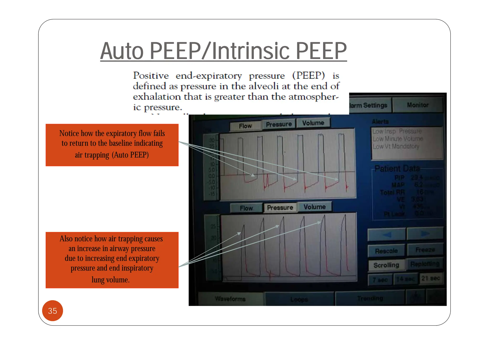 Auto PEEP/Intrinsic PEEP
Auto PEEP/Intrinsic PEEP
Notice how the expiratory flow fails
Notice how the expiratory flow fails
to return to the baseline indicating
air trapping (Auto PEEP)
Also notice how air trapping causes
an increase in airway pressure
y p
due to increasing end expiratory
pressure and end inspiratory
lung volume.
35
 