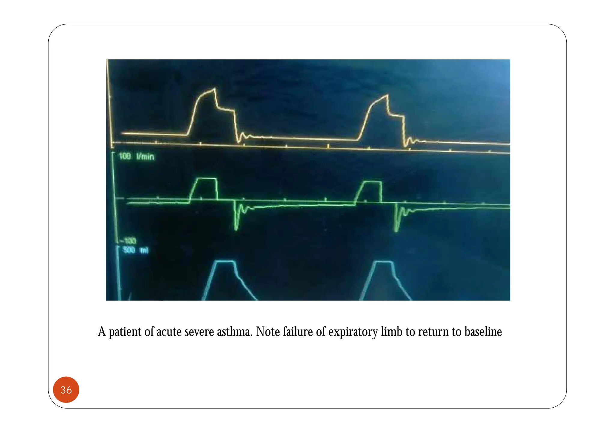 A patient of acute severe asthma. Note failure of expiratory limb to return to baseline
36
 