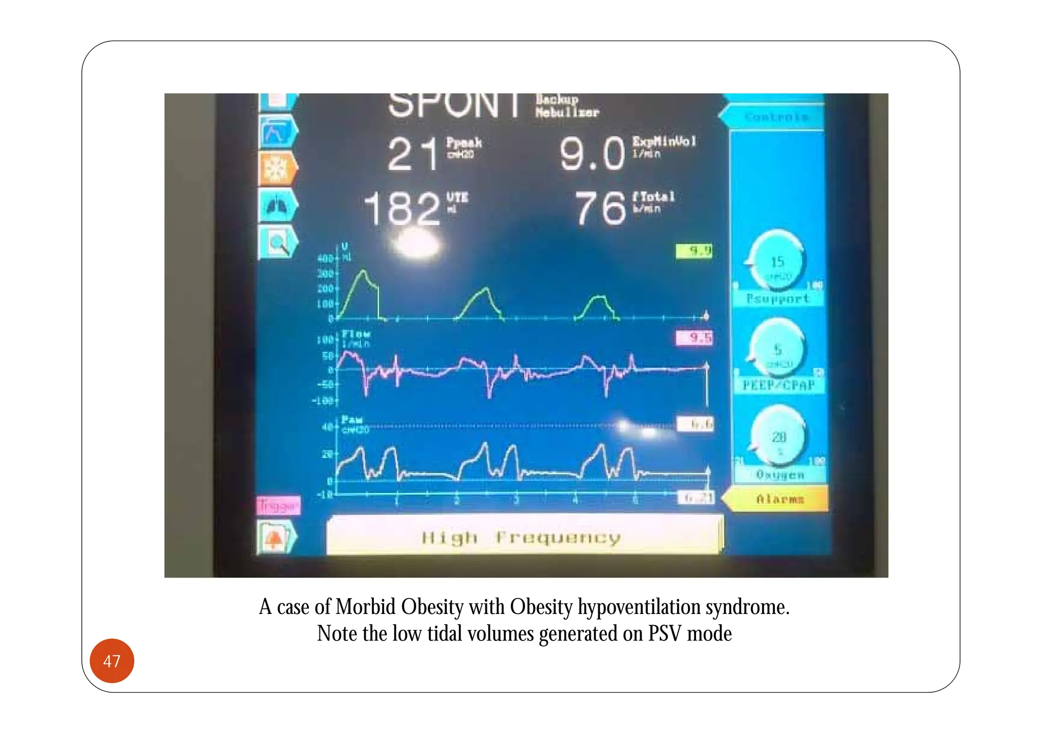 A case of Morbid Obesity with Obesity hypoventilation syndrome.
y y yp y
Note the low tidal volumes generated on PSV mode
47
 