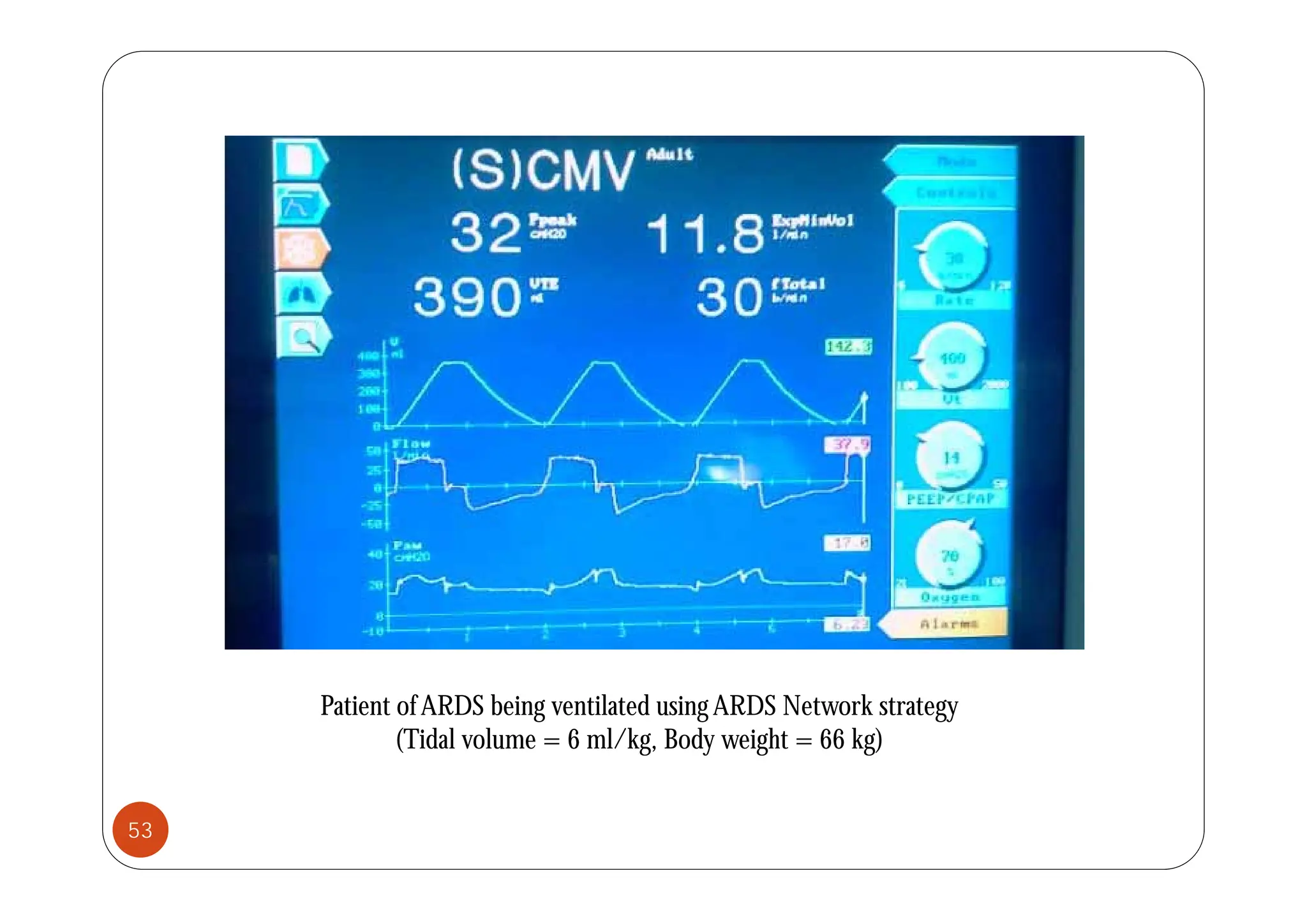 Patient ofARDS being ventilated usingARDS Network strategy
(Tidal volume = 6 ml/kg, Body weight = 66 kg)
53
 