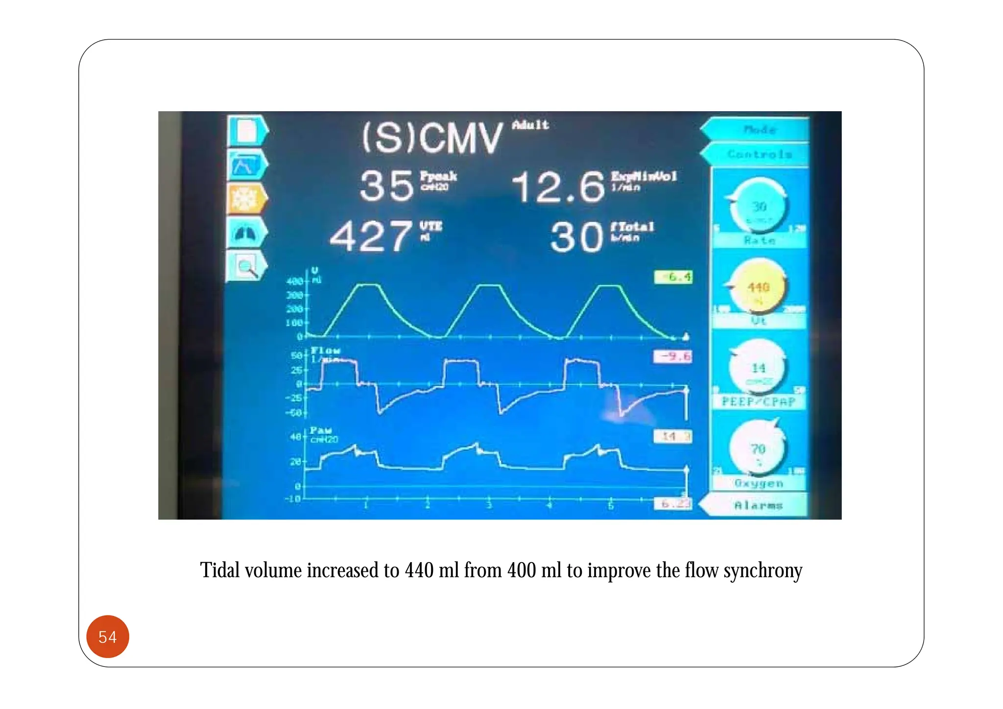 Tidal volume increased to 440 ml from 400 ml to improve the flow synchrony
54
 