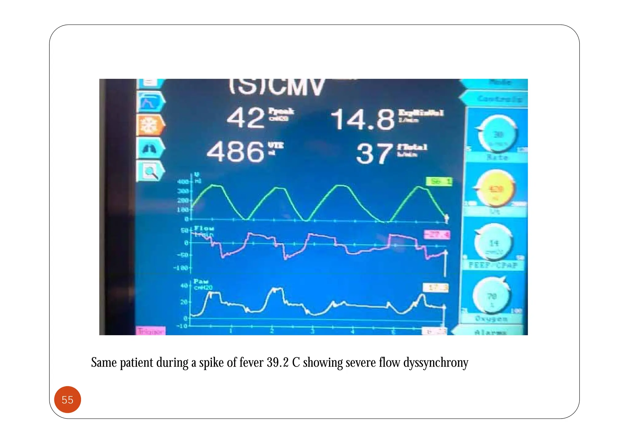 Same patient during a spike of fever 39.2 C showing severe flow dyssynchrony
55
 