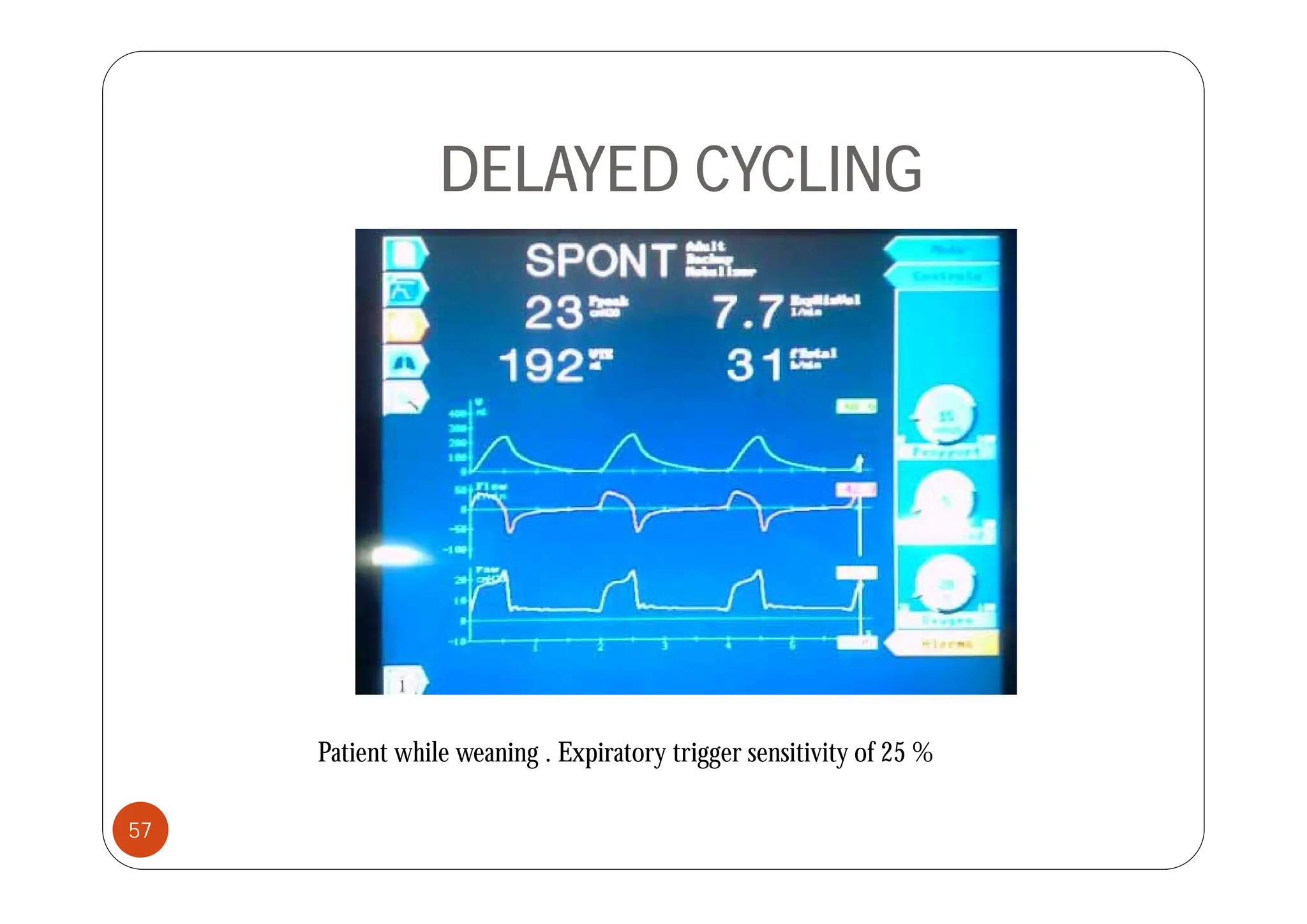 DELAYED CYCLING
Patient while weaning . Expiratory trigger sensitivity of 25 %
57
 