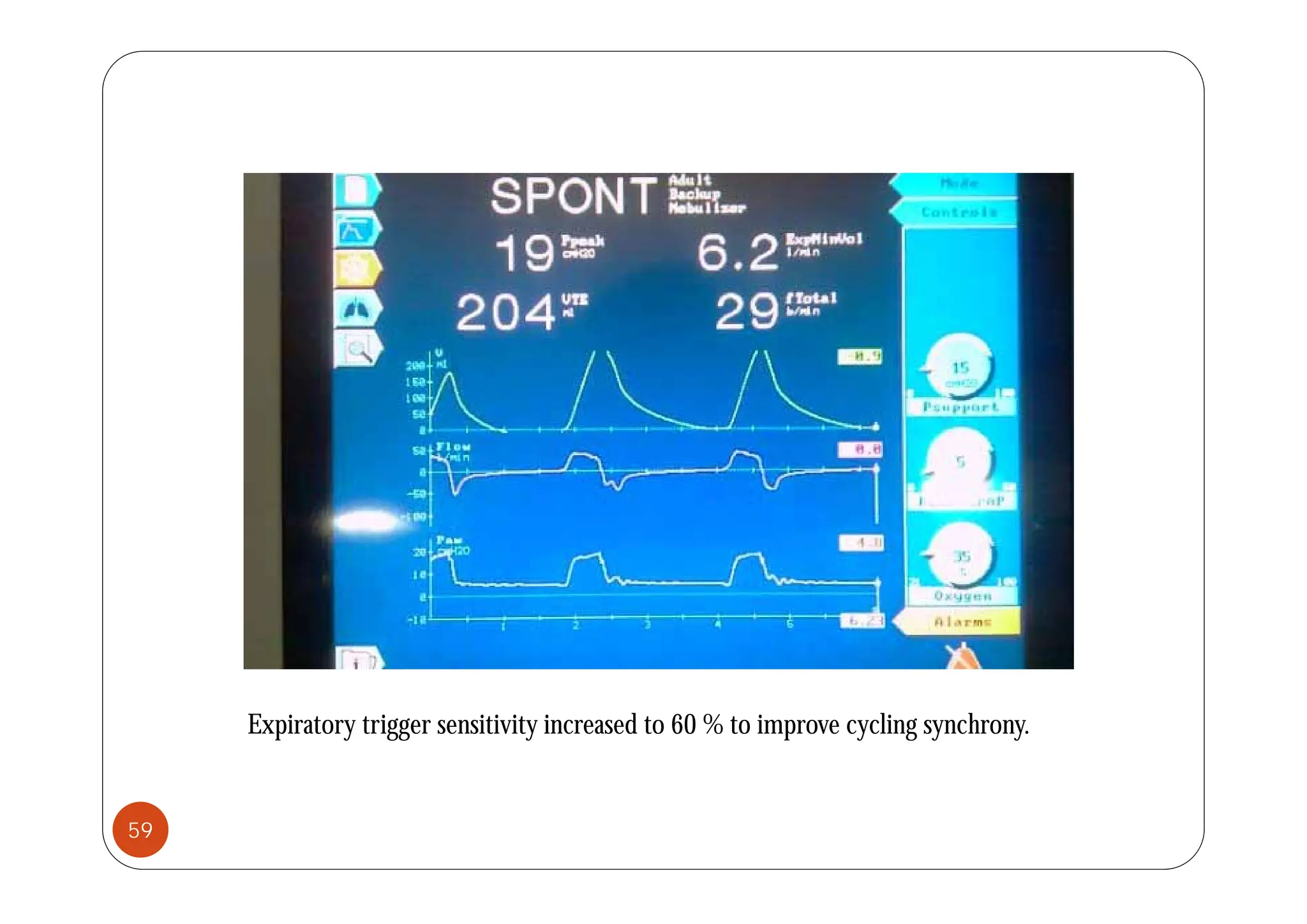 Expiratory trigger sensitivity increased to 60 % to improve cycling synchrony.
59
 