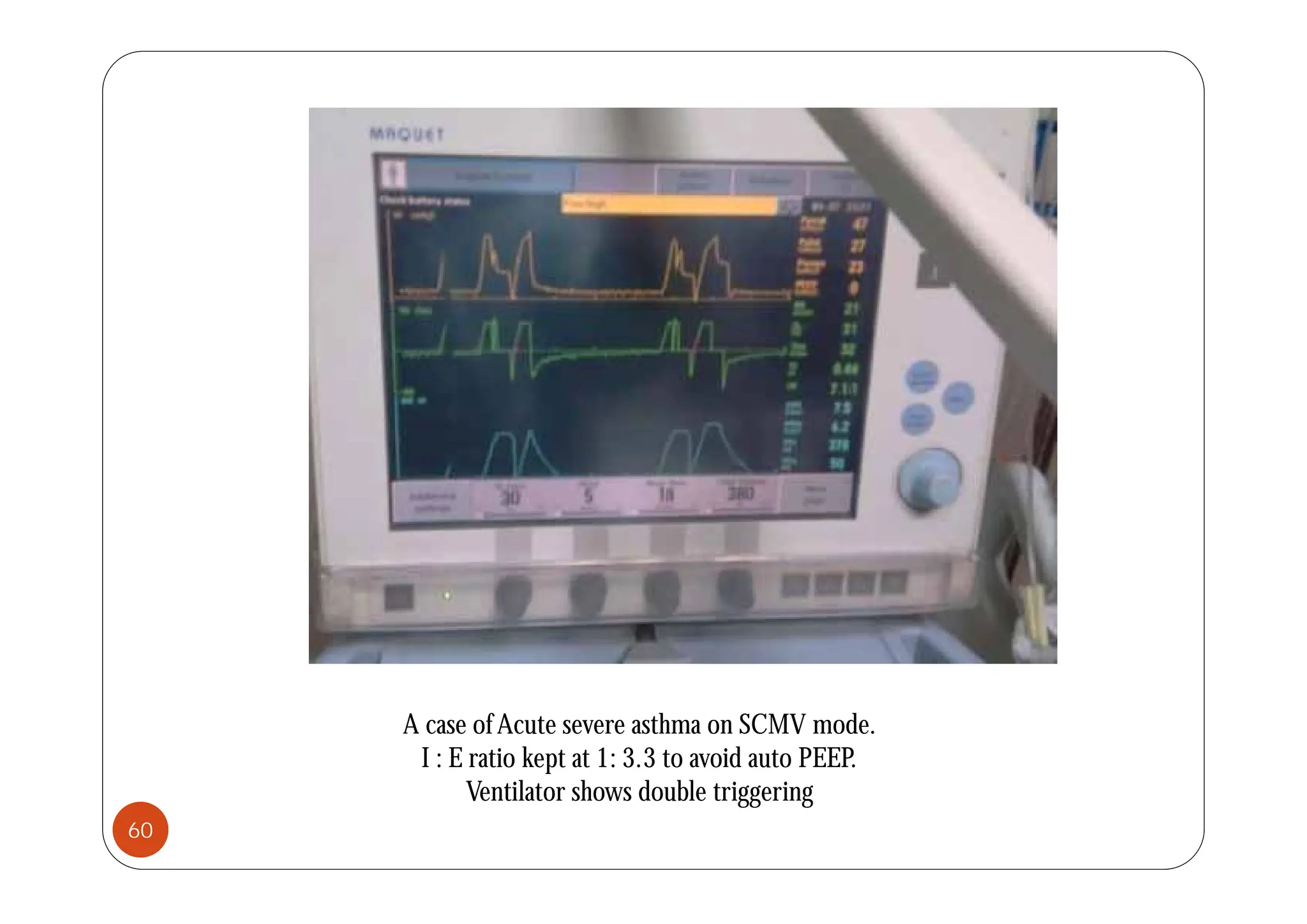 A case ofAcute severe asthma on SCMV mode.
I : E ratio kept at 1: 3.3 to avoid auto PEEP.
Ventilator shows double triggering
60
 