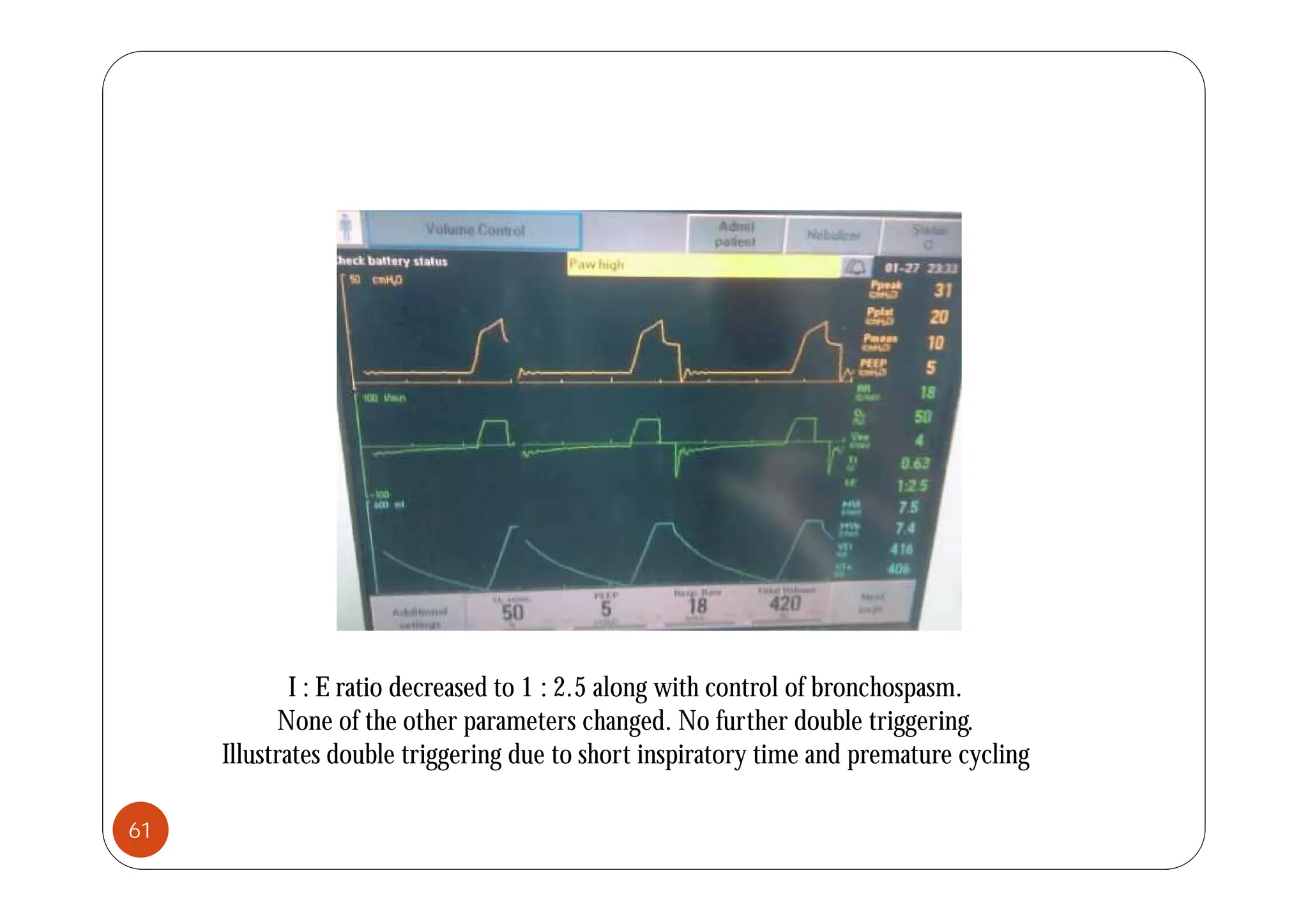 I : E ratio decreased to 1 : 2.5 along with control of bronchospasm.
None of the other parameters changed. No further double triggering.
Illustrates double triggering due to short inspiratory time and premature cycling
61
 