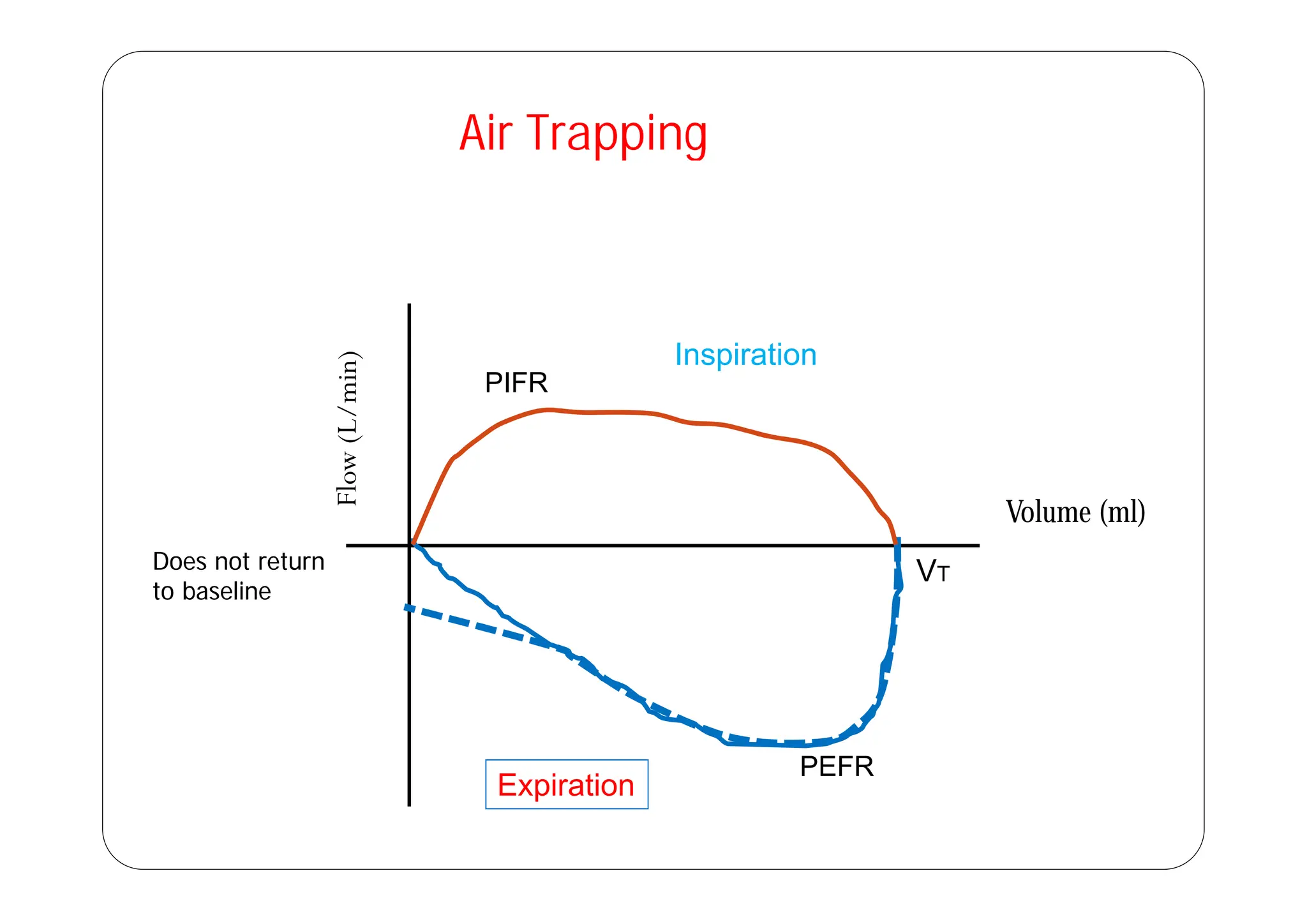 Air Trapping
Air Trapping
Air Trapping
Air Trapping
Inspiration
Inspiration
PIFR
Volume (ml)
VT
Does not return
Does not return VT
Does not return
Does not return
to baseline
to baseline
E i ti
PEFR
Expiration
 