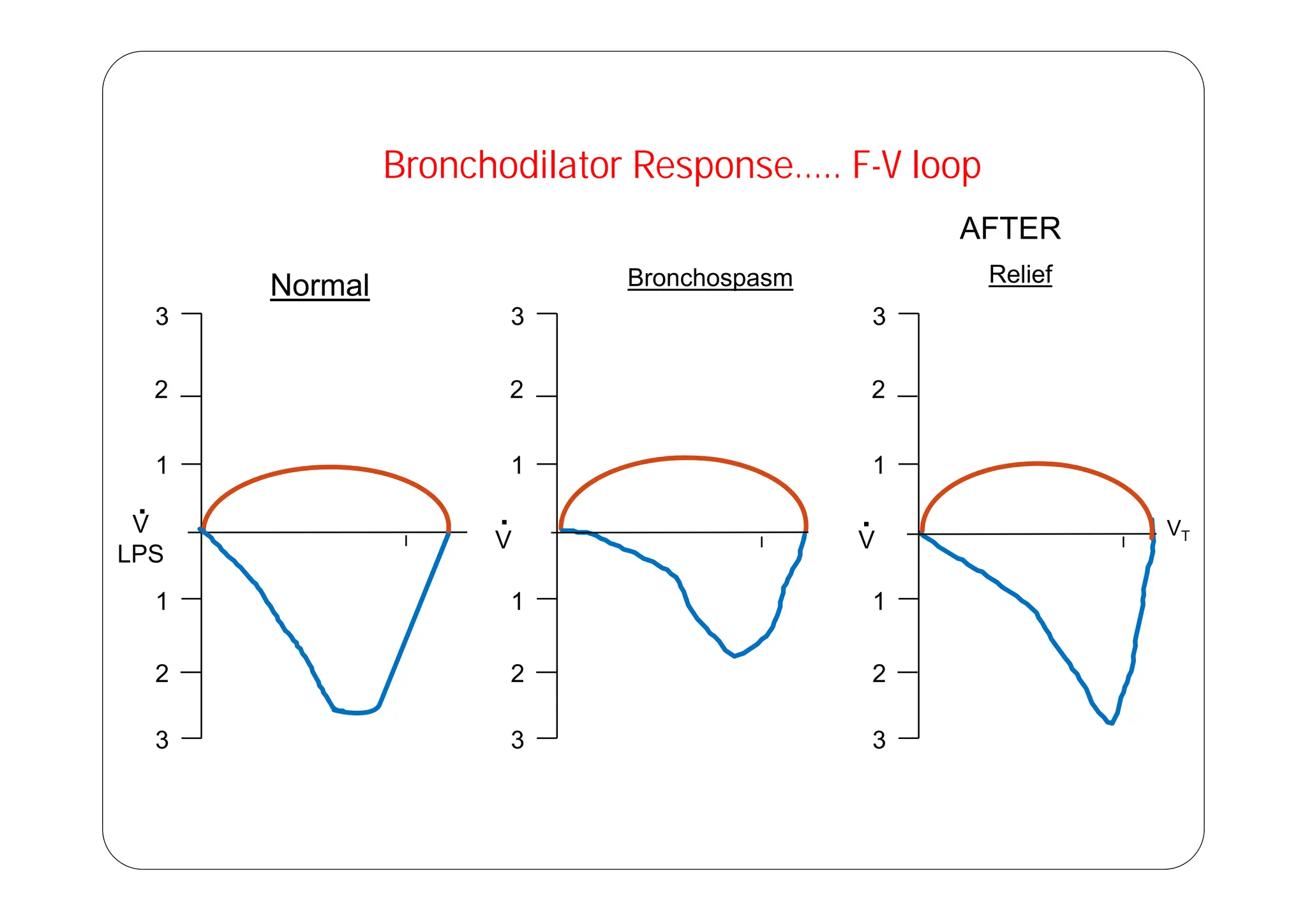 Bronchodilator Response….. F-V loop
AFTER
3
Normal Bronchospasm Relief
3 3
2
1
2
1
2
1
1
V
LPS
.
VT
1
V
.
1
V
.
1
2
1
2
1
2
2
3
2
3
2
3
 