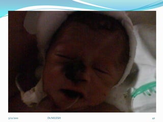 Maintaining a patent CPAP delivery circuit 