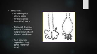 • Barotrauma
• Air leaking into
pleural space
• Air leaking into
interstitial space
• Tearing at Bronchio-
Alveolar Junction as
lung is recruited and
allowed to collapse
• Most occurs in
dependent lung
zones (transition
zone)
 