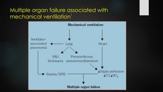 Multiple organ failure associated with
mechanical ventilation1
 