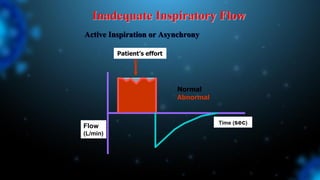 Inadequate Inspiratory Flow
Flow
(L/min)
Time (sec)
Normal
Abnormal
Active Inspiration or Asynchrony
Patient’s effort
 