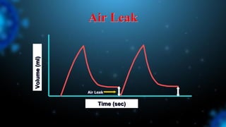 Air Leak
Volume
(ml)
Time (sec)
Air Leak
 