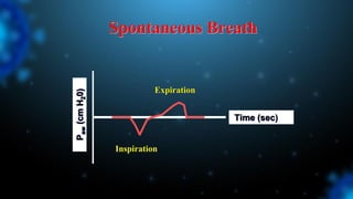 Spontaneous Breath
P
aw
(cm
H
2
0)
Time (sec)
Inspiration
Expiration
 