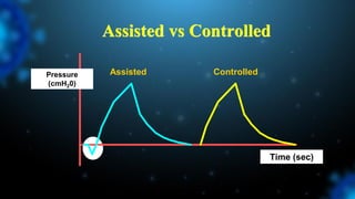 Assisted vs Controlled
Assisted Controlled
Pressure
(cmH20)
Time (sec)
 