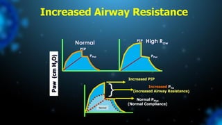 Paw
(cm
H
2
O)
Normal
Normal PPlat
(Normal Compliance)
Increased PIP
} Increased PTA
(increased Airway Resistance)
Normal
PIP
PPlat
High Raw
PIP
PPlat
Increased Airway Resistance
 