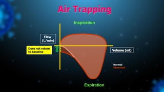 Air Trapping
Inspiration
Expiration
Volume (ml)
Flow
(L/min)
Does not return
to baseline
Normal
Abnormal
 