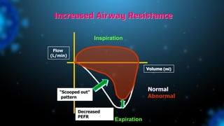 Increased Airway Resistance
Inspiration
Expiration
Volume (ml)
Flow
(L/min)
Decreased
PEFR
Normal
Abnormal
“Scooped out”
pattern
 