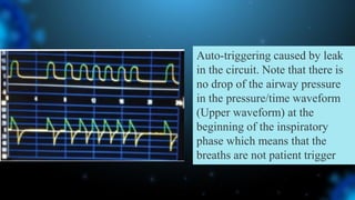 Auto-triggering caused by leak
in the circuit. Note that there is
no drop of the airway pressure
in the pressure/time waveform
(Upper waveform) at the
beginning of the inspiratory
phase which means that the
breaths are not patient trigger
 