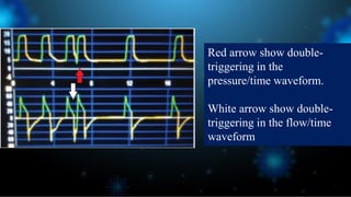 Red arrow show double-
triggering in the
pressure/time waveform.
White arrow show double-
triggering in the flow/time
waveform
 