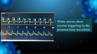 White arrows show
reverse triggering in the
pressure/time waveform
 