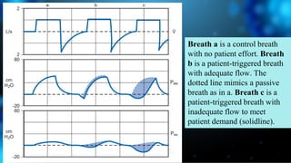 Breath a is a control breath
with no patient effort. Breath
b is a patient-triggered breath
with adequate flow. The
dotted line mimics a passive
breath as in a. Breath c is a
patient-triggered breath with
inadequate flow to meet
patient demand (solidline).
 