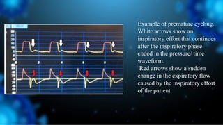 Example of premature cycling.
White arrows show an
inspiratory effort that continues
after the inspiratory phase
ended in the pressure/ time
waveform.
Red arrows show a sudden
change in the expiratory flow
caused by the inspiratory effort
of the patient
 