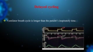 Delayed cycling
 Ventilator breath cycle is longer than the patient’s inspiratory time.
 